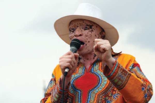 Stop the stigma against Albinos– Kgosietsile