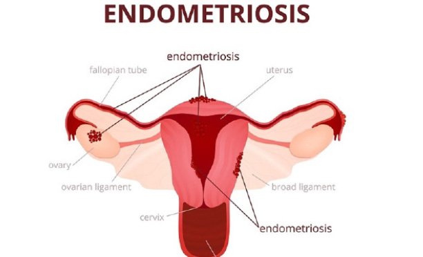 The pain of endometriosis – making a diagnosis (Part Two)